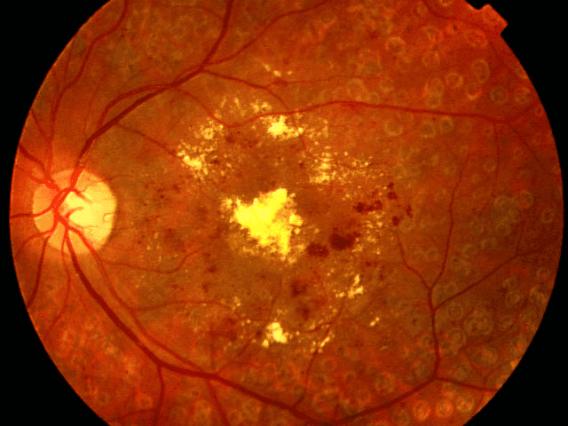 Retinopatía Diabética Proliferativa