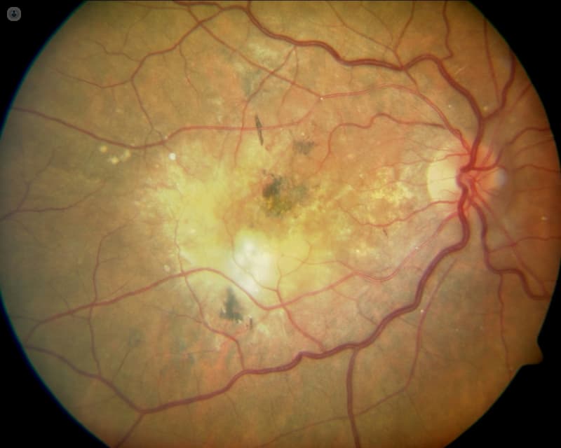 Degeneración Macular Relacionada con la Edad (DMRE)